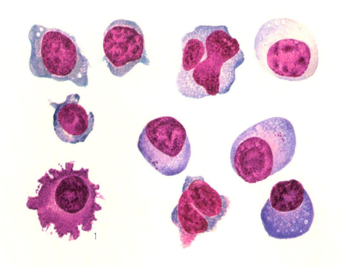 图30 幼稚浆细胞